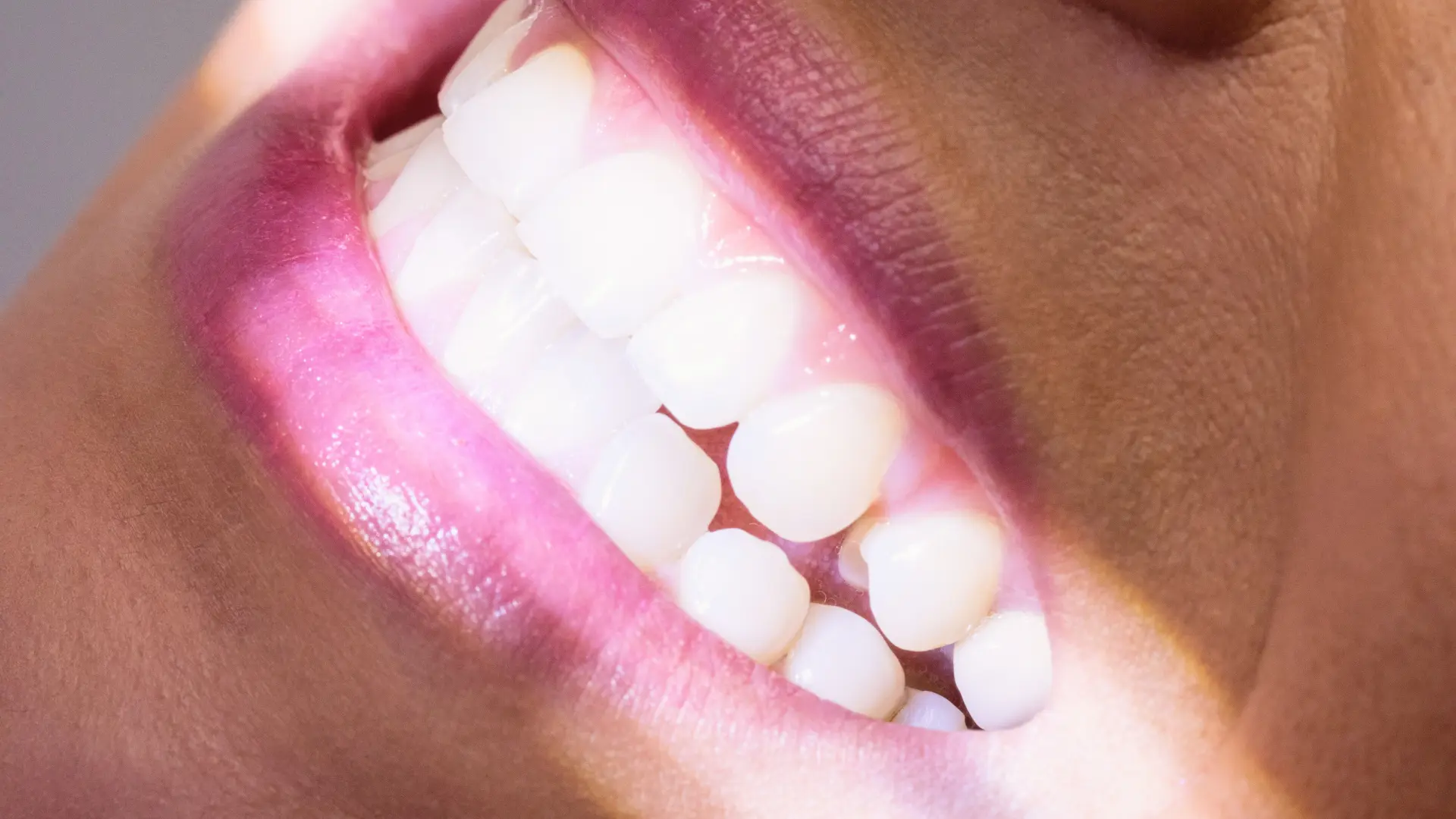 Teeth Whitening