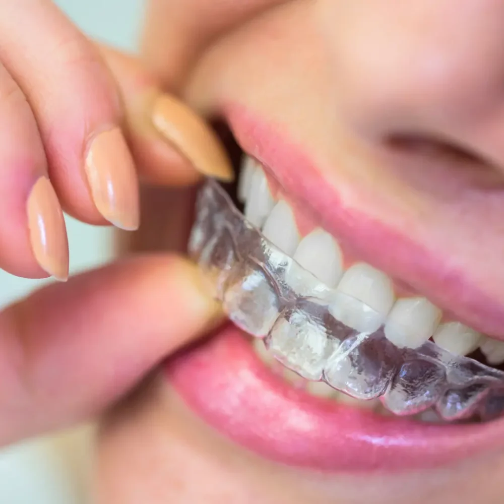 Invisalign nasıl yapılır