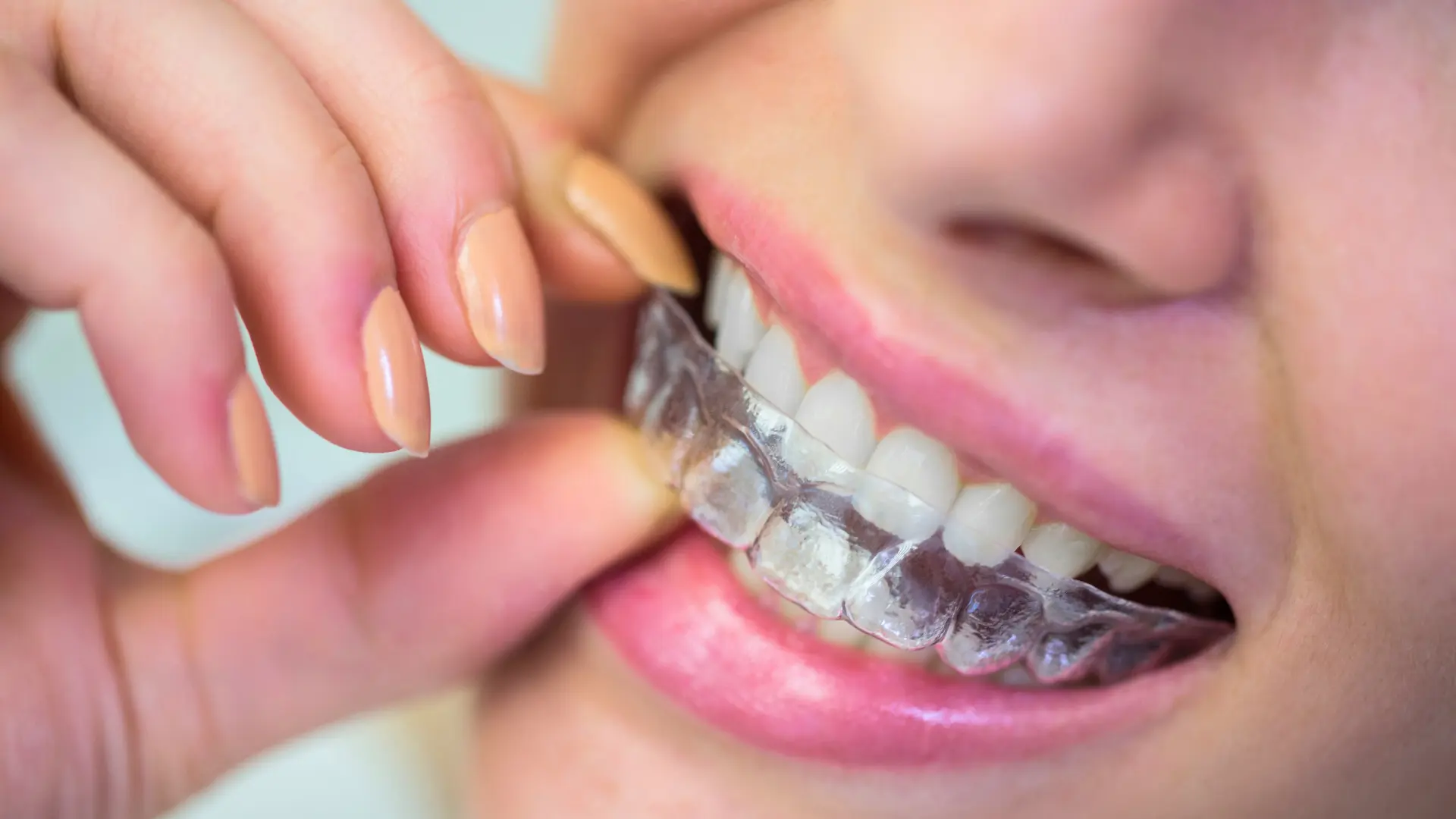 Invisalign nasıl yapılır